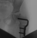 roentgenbild_von_der_klammer.jpg